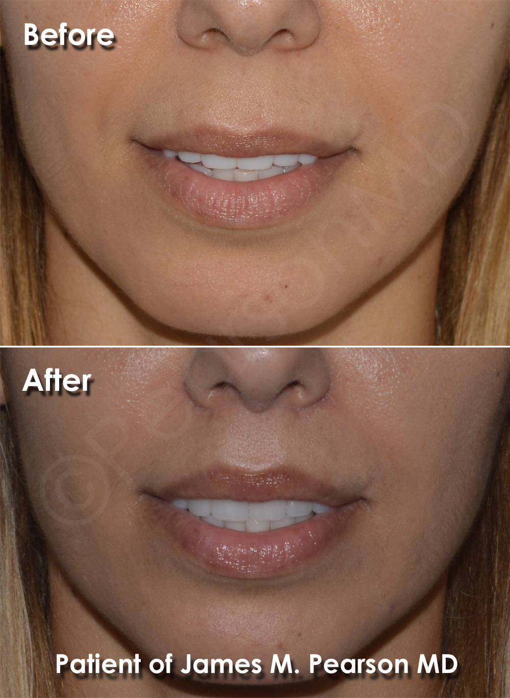 Lip Lift Photos Before & After Dr. James Pearson Facial Plastic Surgery