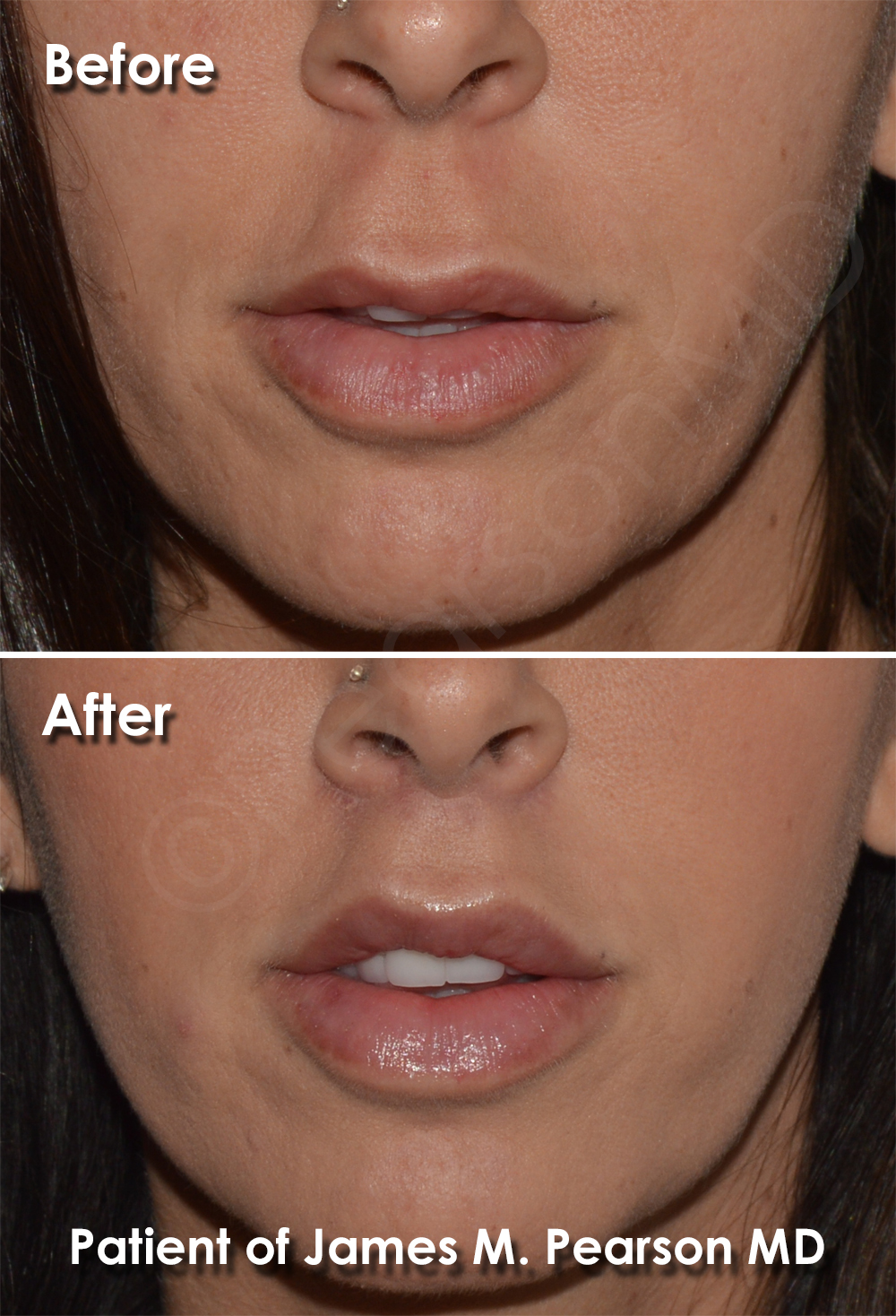 Lip Lift Photos Before & After Dr. James Pearson Facial Plastic Surgery
