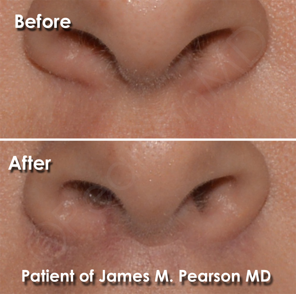 Lip Lift Photos Before & After Dr. James Pearson Facial Plastic Surgery