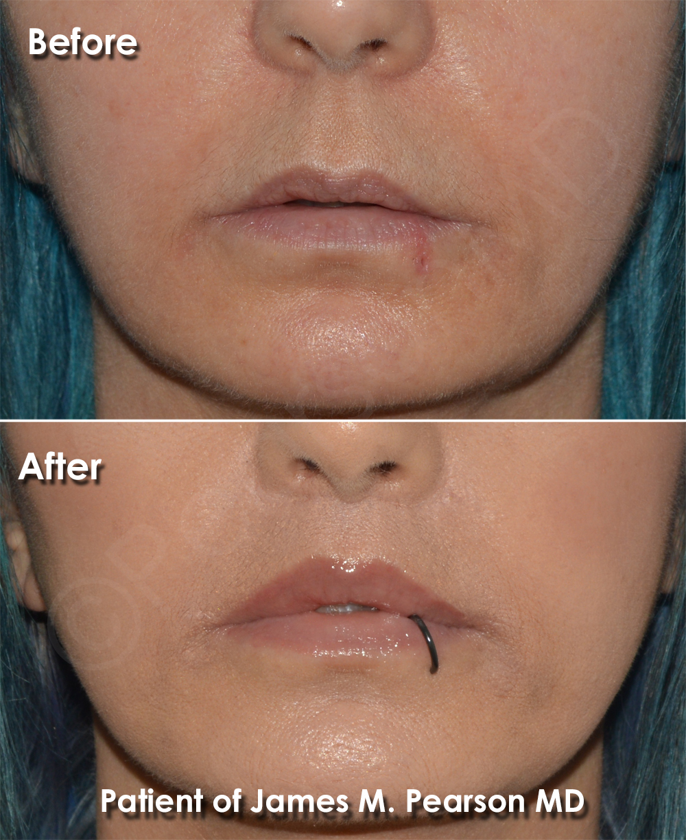 Lip Lift Photos Before & After Dr. James Pearson Facial Plastic Surgery
