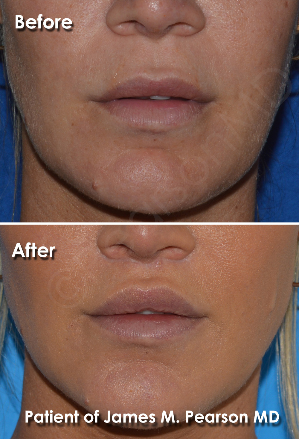 Laser Treatment For Upper Lip chartdevelopment