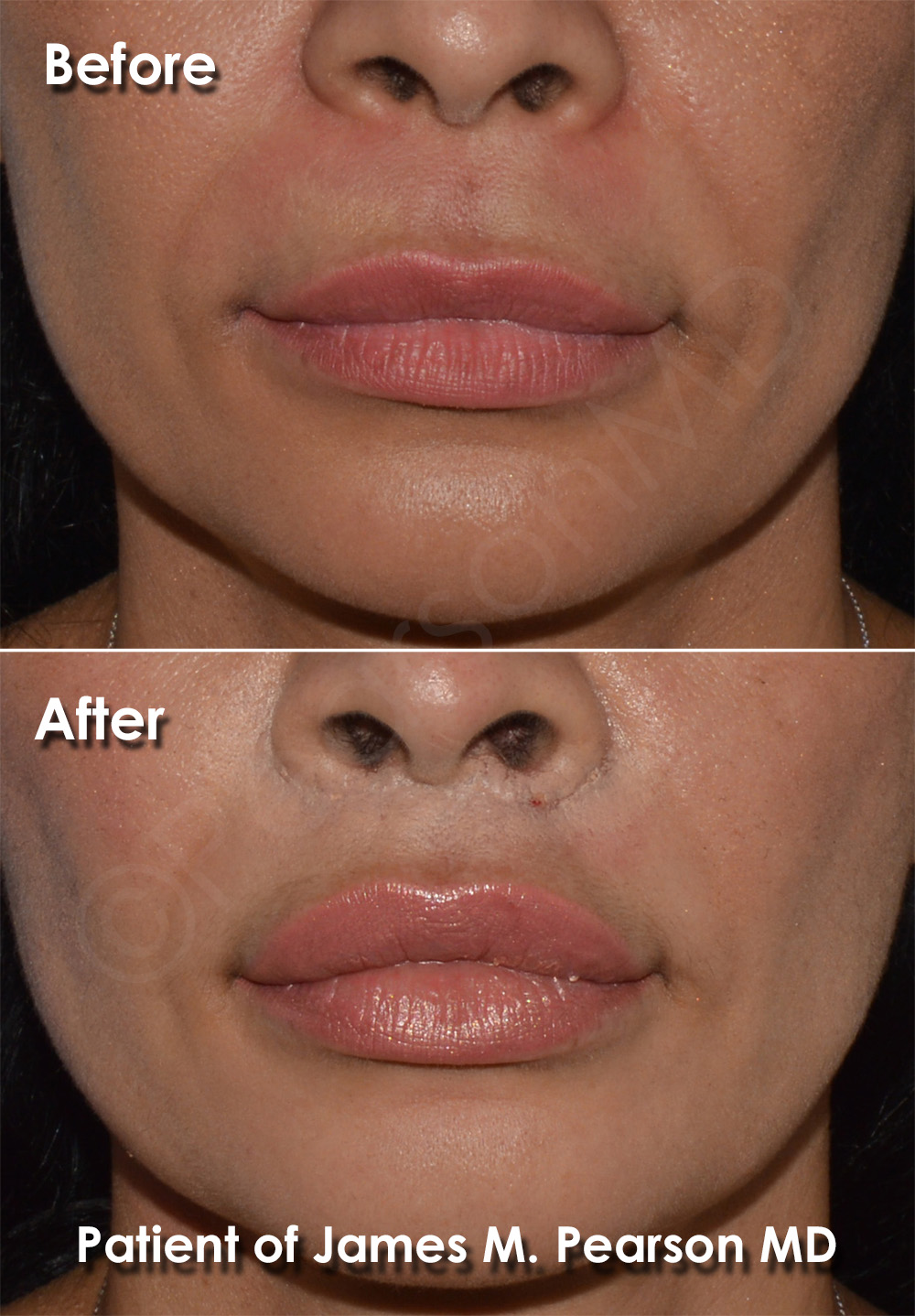 Lip Lift Photos Before & After Dr. James Pearson Facial Plastic Surgery