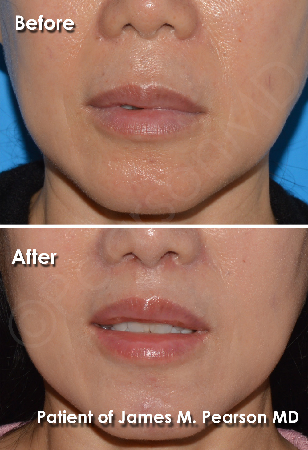 Lip Lift Photos Before & After Dr. James Pearson Facial Plastic Surgery
