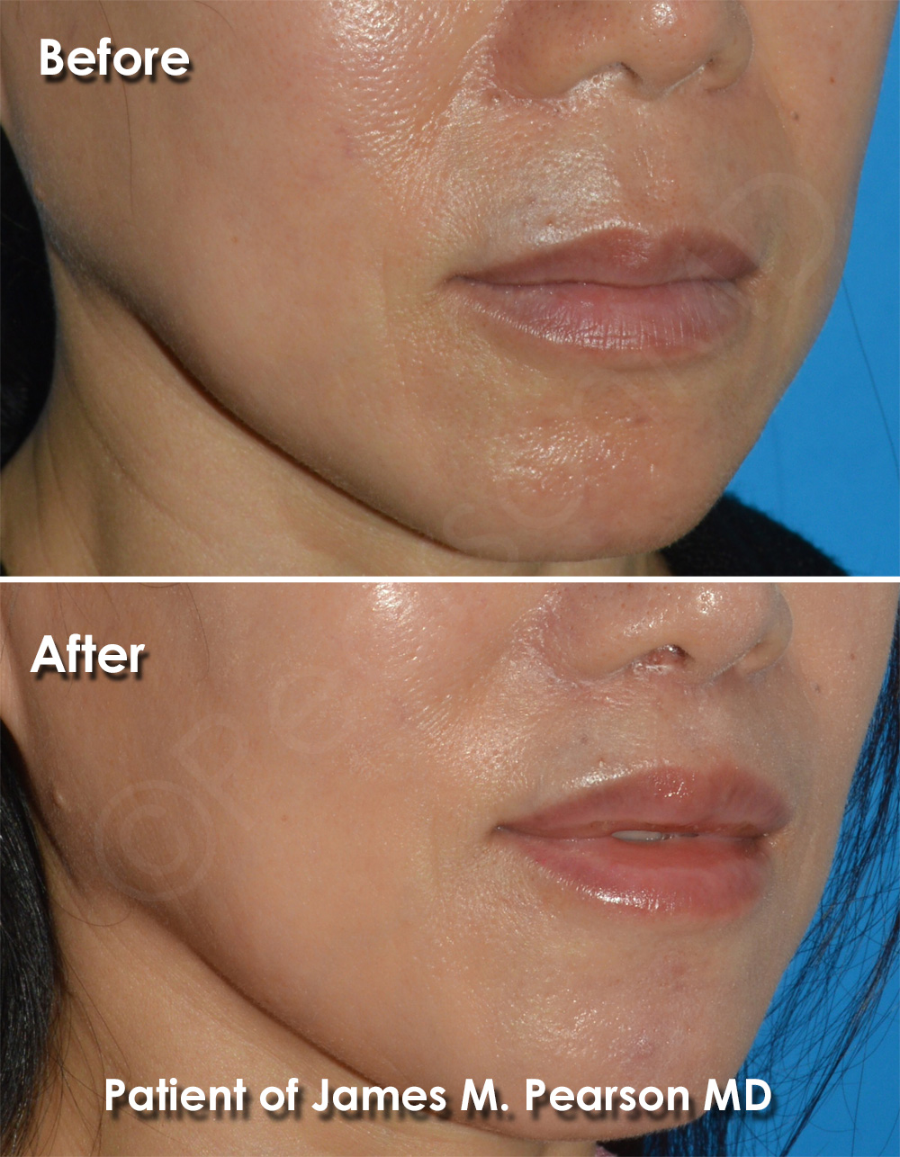 Lip Lift Photos Before & After Dr. James Pearson Facial Plastic Surgery