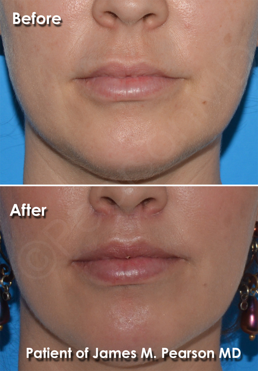 Lip Lift Photos Before & After Dr. James Pearson Facial Plastic Surgery