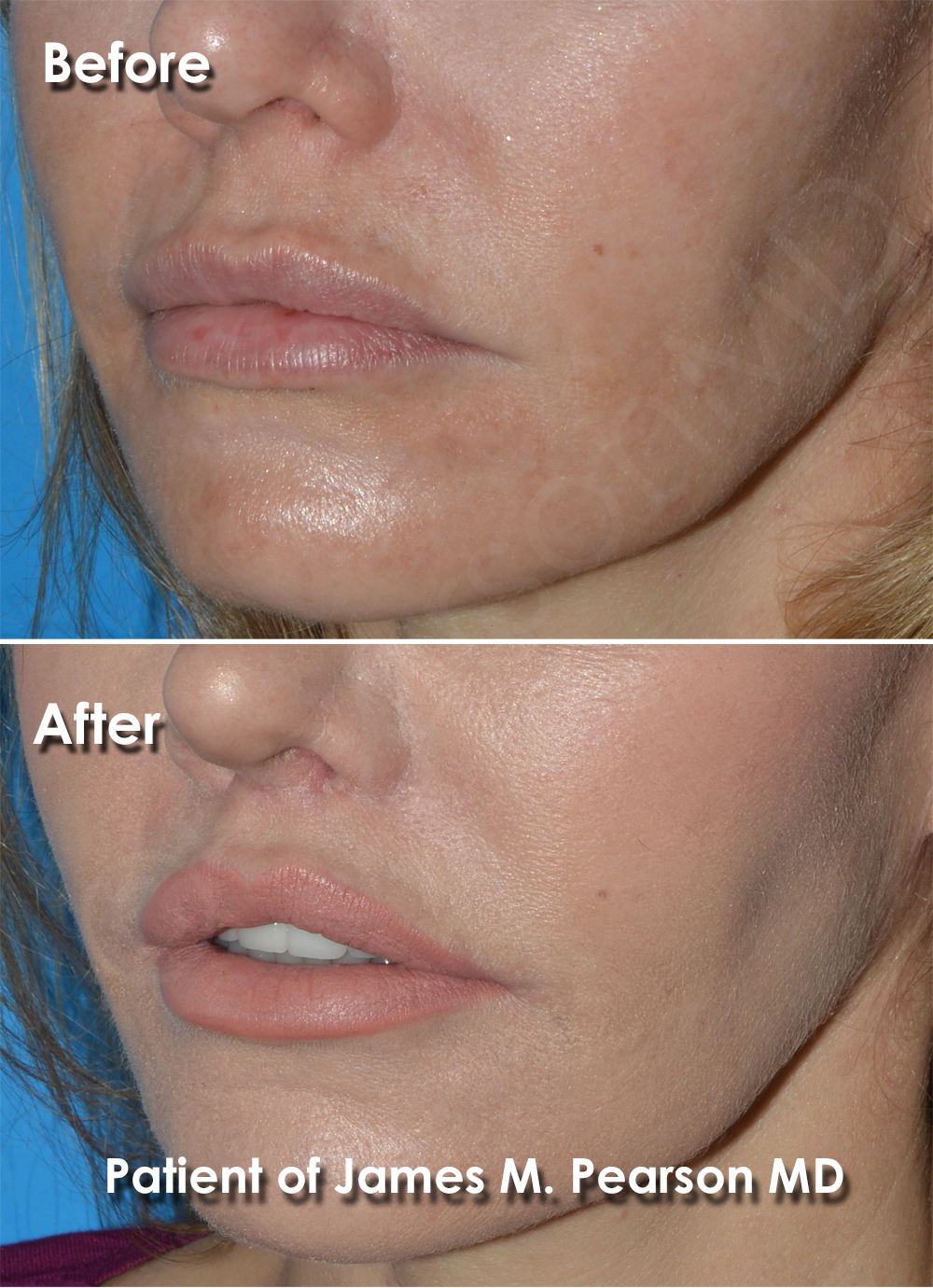 Lip Lift Photos Before & After Dr. James Pearson Facial Plastic Surgery