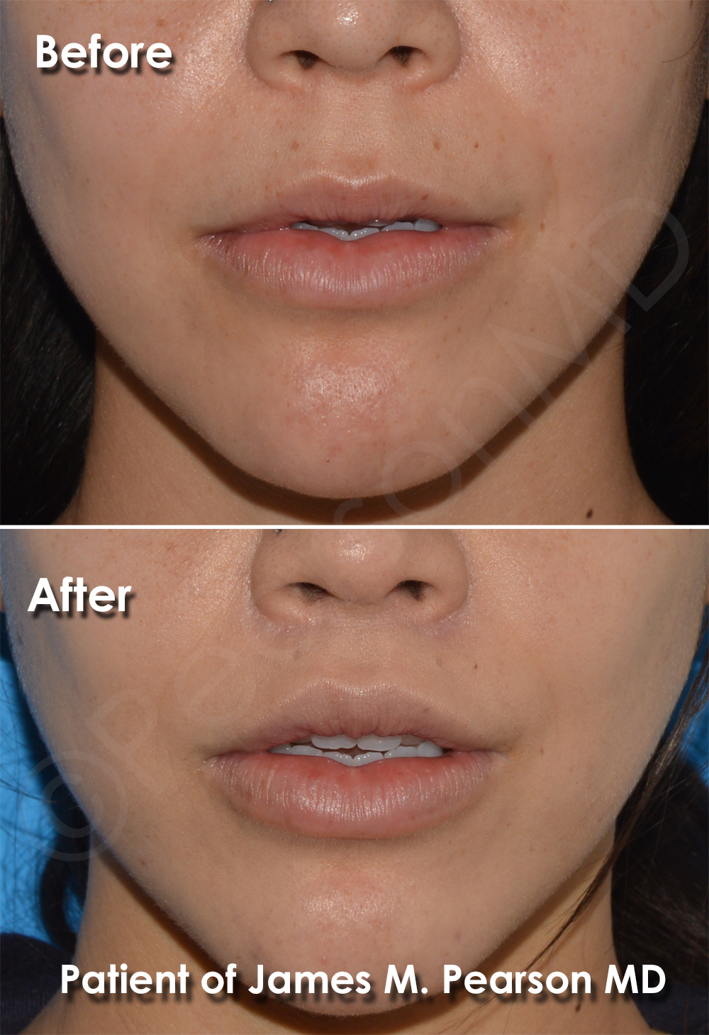 Lip Lift Photos Before & After Dr. James Pearson Facial Plastic Surgery