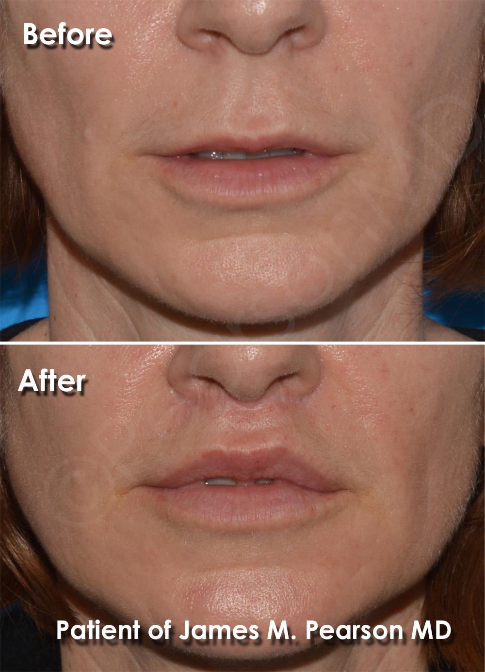 Lip Lift Photos Before & After Dr. James Pearson Facial Plastic Surgery