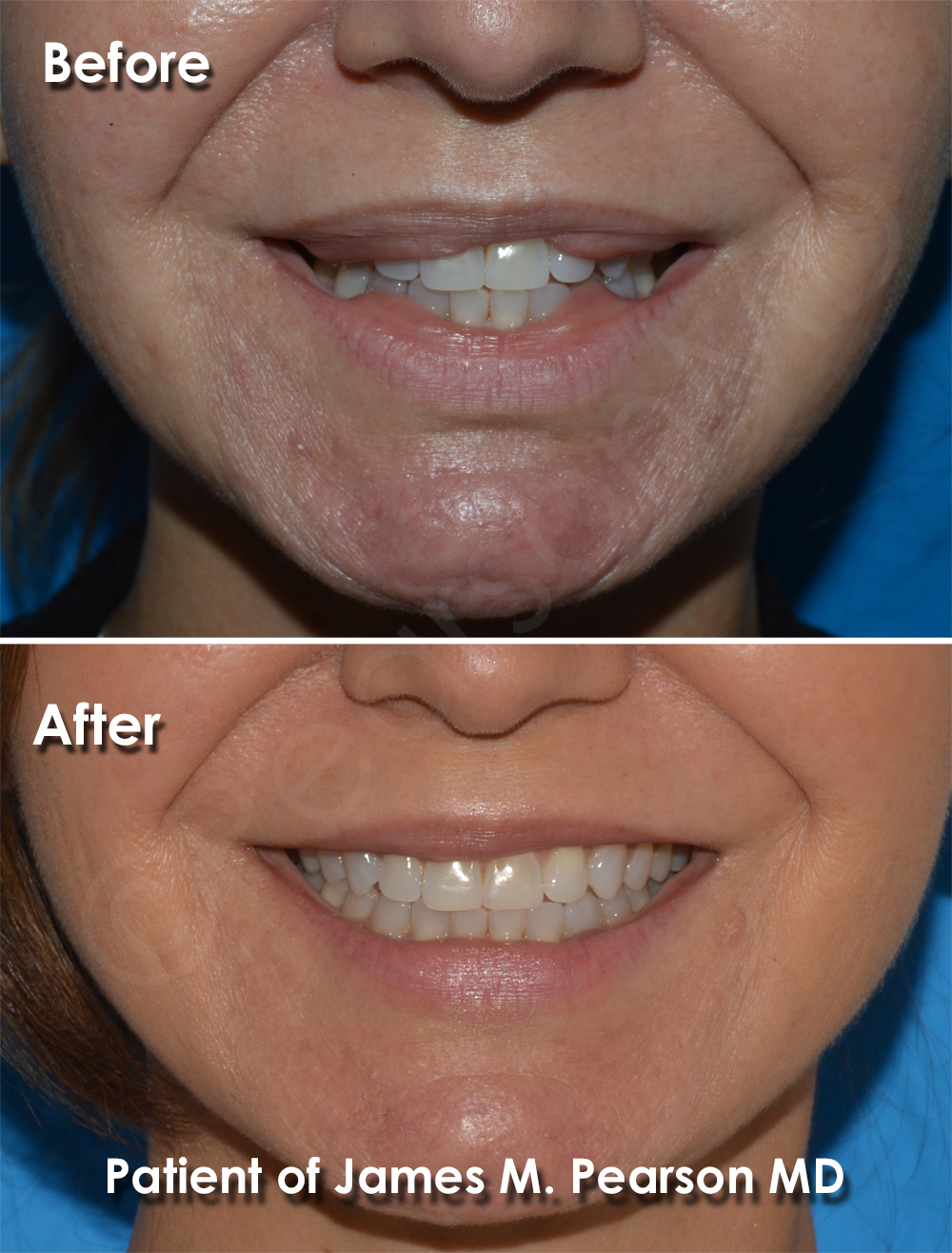 Lip Reduction Dr. James Pearson Facial Plastic Surgery