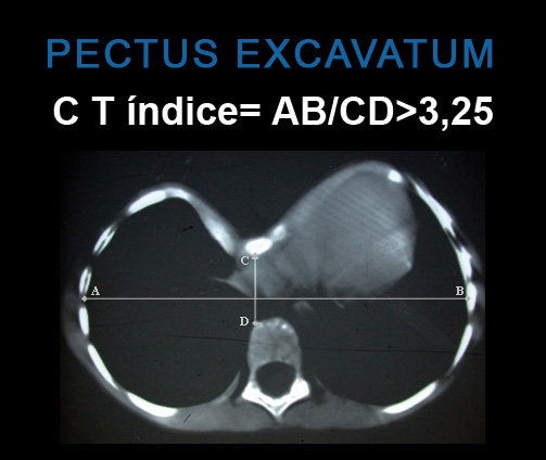 Pectus Forum About Pectus Excavatum y Pectus Carinatum Introduction