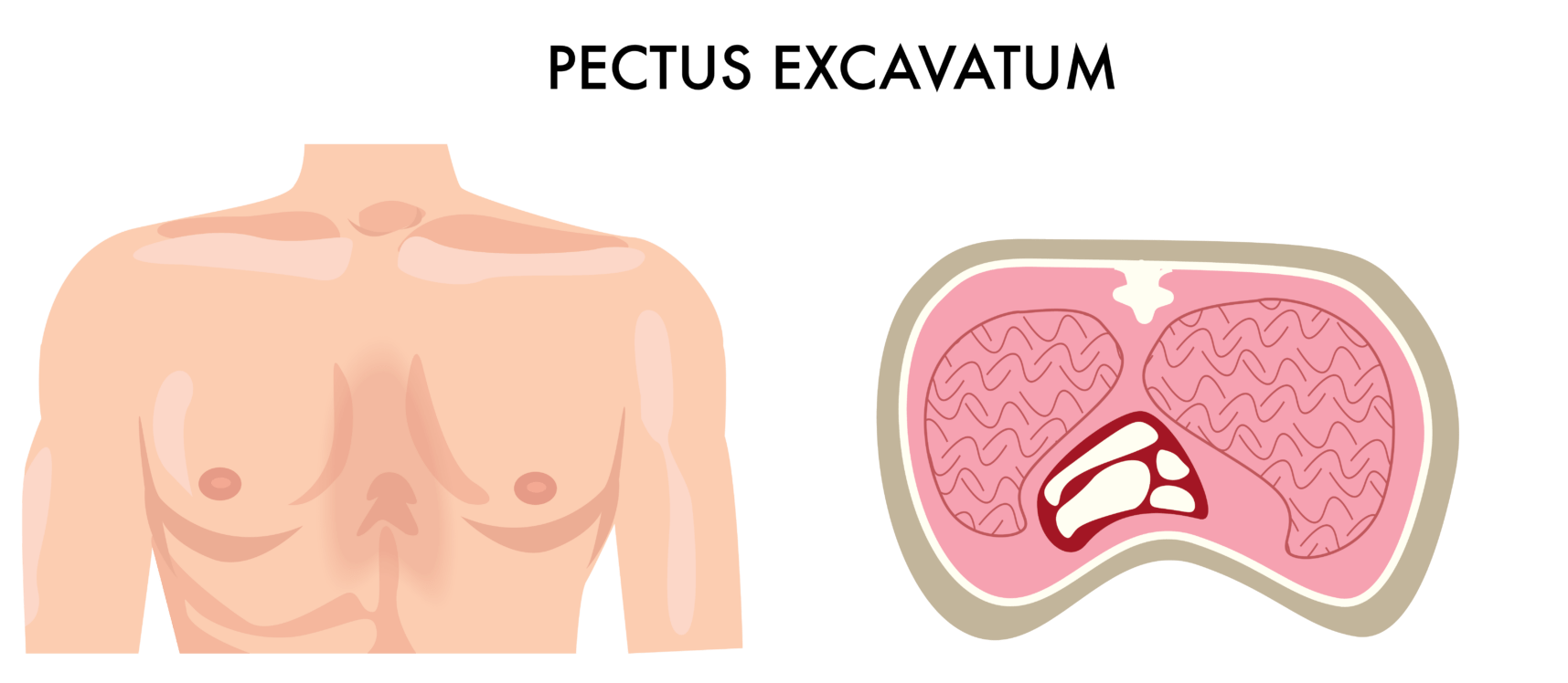 What is Pectus Excavatum