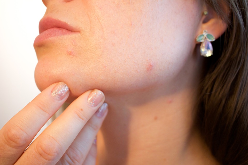 Difference Between Acne and Pimple Clinical Features, Causes