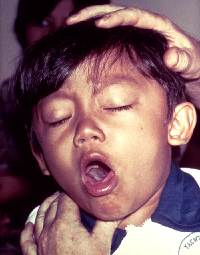 Difference Between Choking and Gagging Causes, How to Stop a Baby