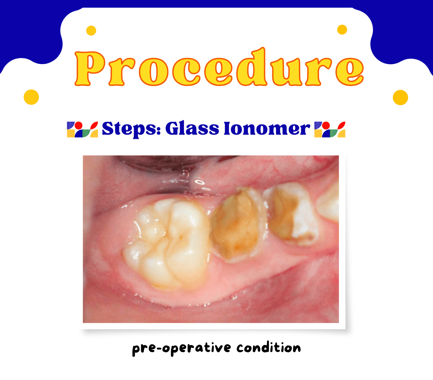 Procedure Glass Ionomer Pediatric Dentistry Workbook