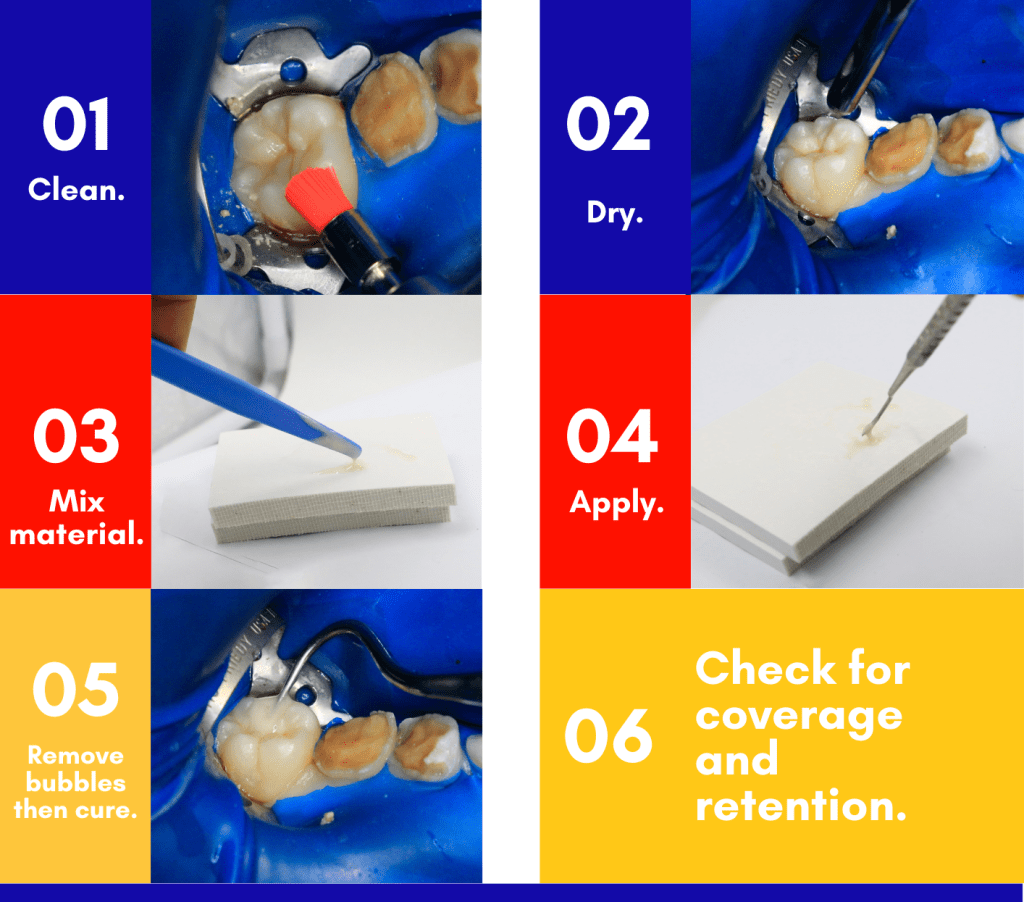 Procedure Glass Ionomer Pediatric Dentistry Workbook