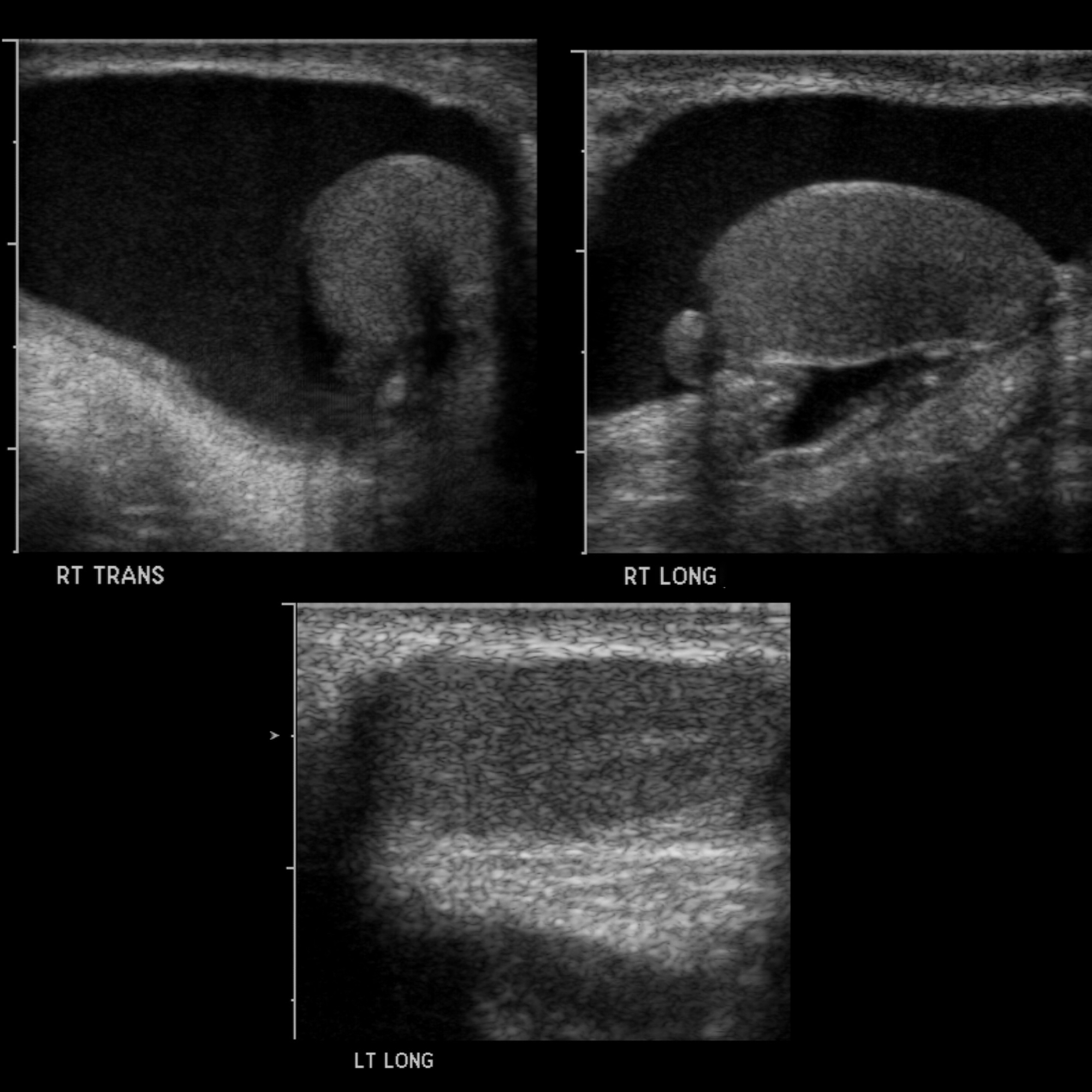 Pediatric Hydrocele Pediatric Radiology Reference Article Pediatric