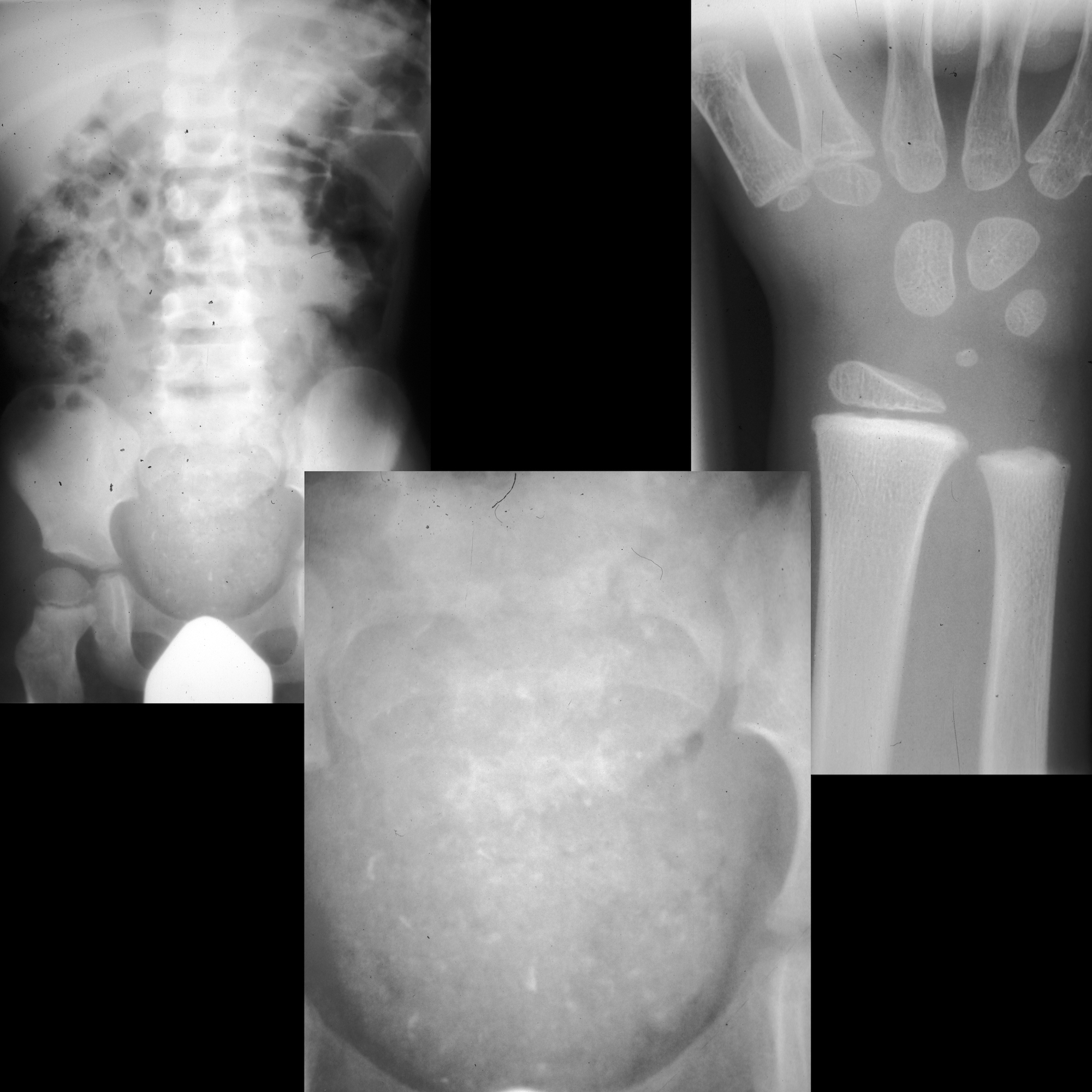 Lead Poisoning Pediatric Radiology Reference Article Pediatric
