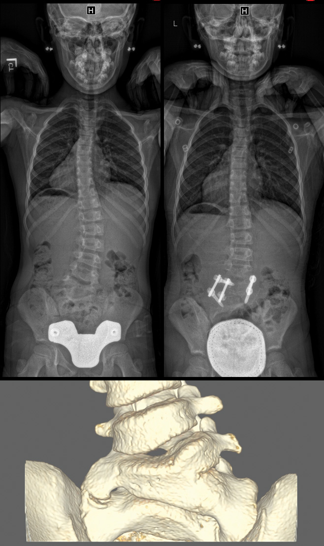 Growing Rods for Pediatric Scoliosis Michael G. Vitale MD MPH