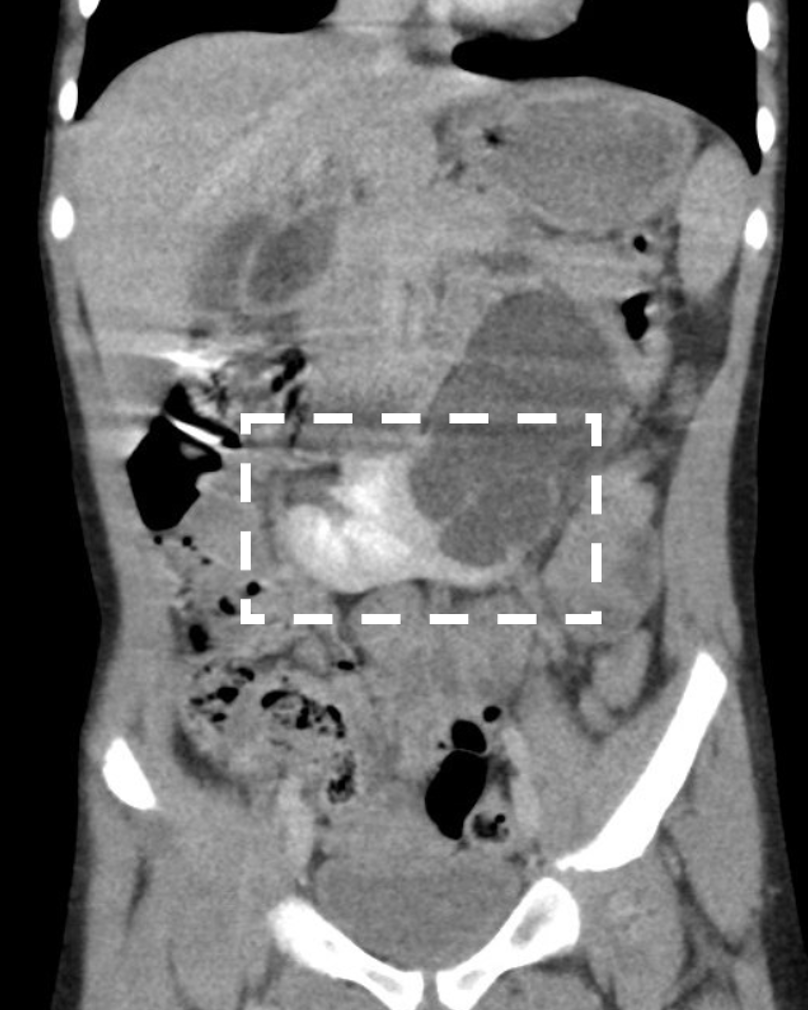 Duplex, Migration, and Fusion Anomalies Pediatric Urology Book