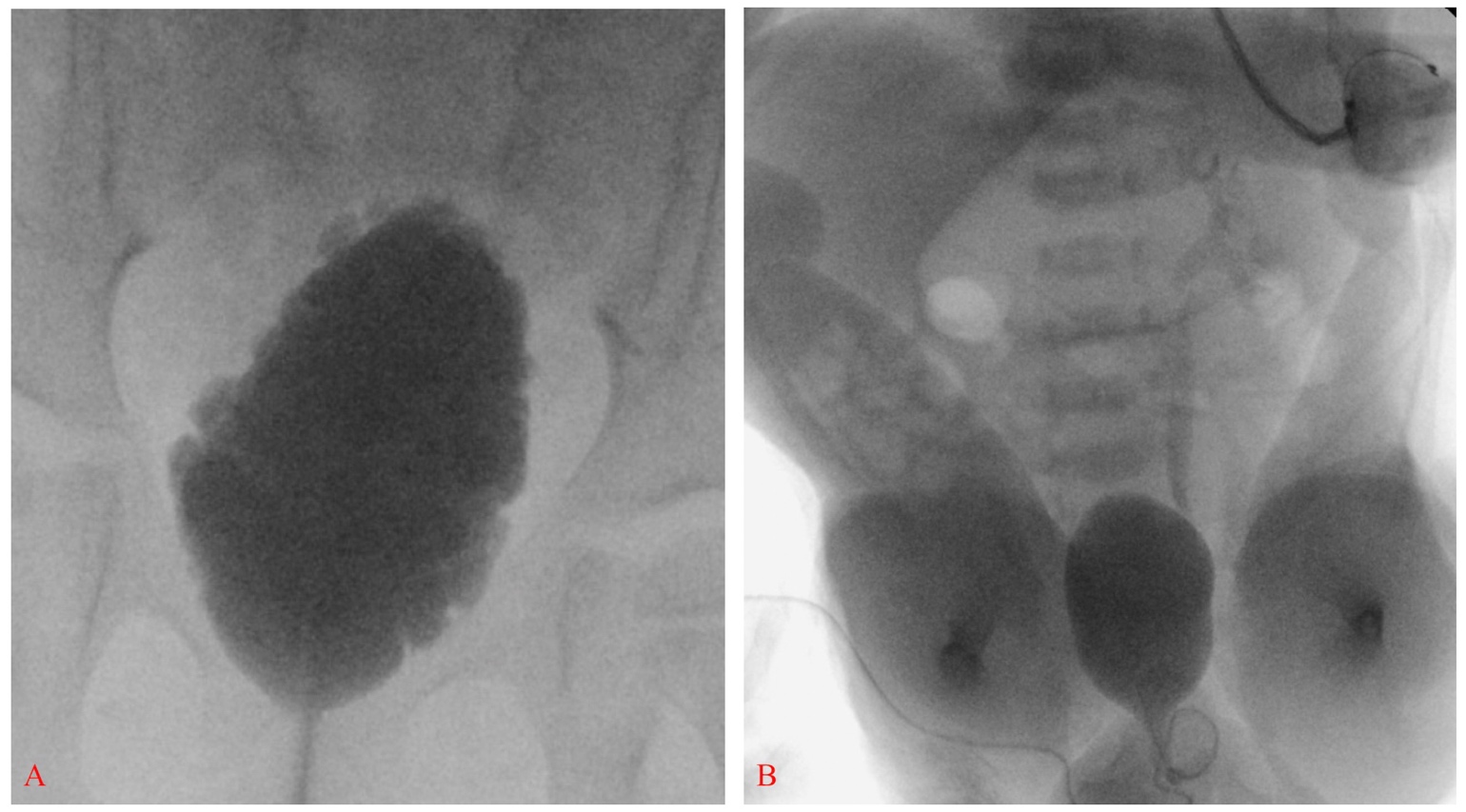 Neurogenic Bladder Pediatric Urology Book
