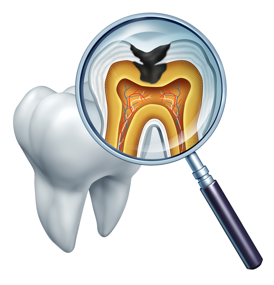 Pella, IA Dentist Explains Root Canal Therapy Pella, IA