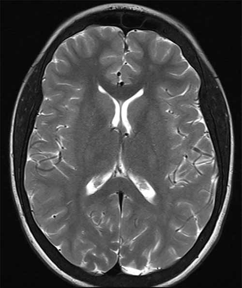 【医学图像处理】MRI T1, T2 PD加权成像 张朋艺的博客 ZhangPY Blog