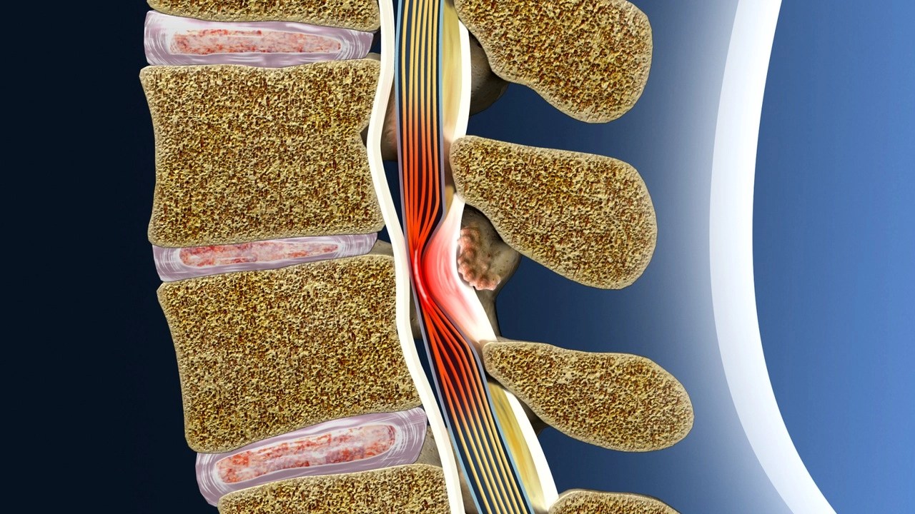 New Findings for Treating Lumbar Spinal Stenosis A 5 Year Study on the