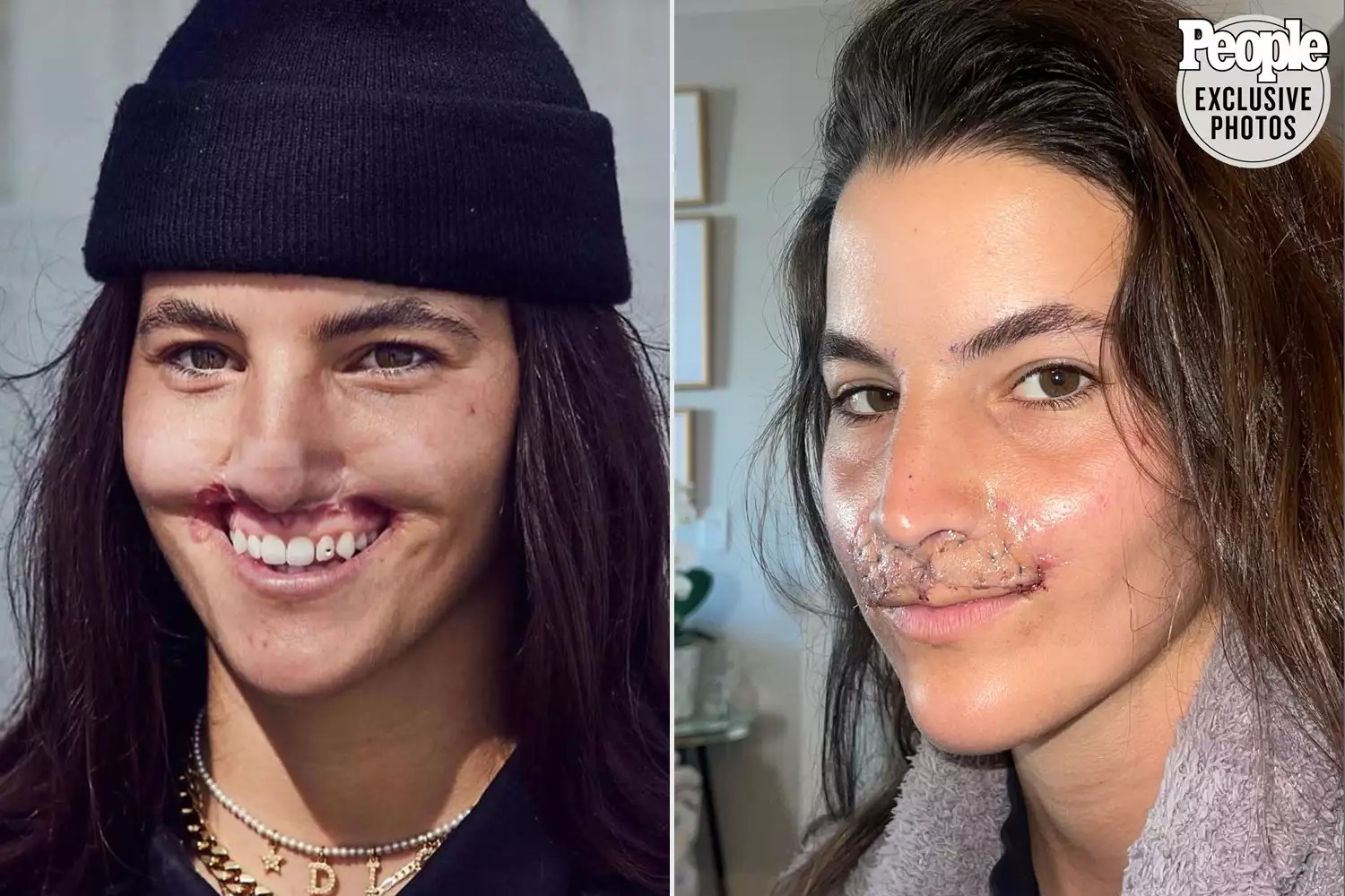 Brooklinn Khoury Shows Off Results After Final Lip Reconstruction Surgery: &lsquo;Almost at the Finish Line&rsquo;