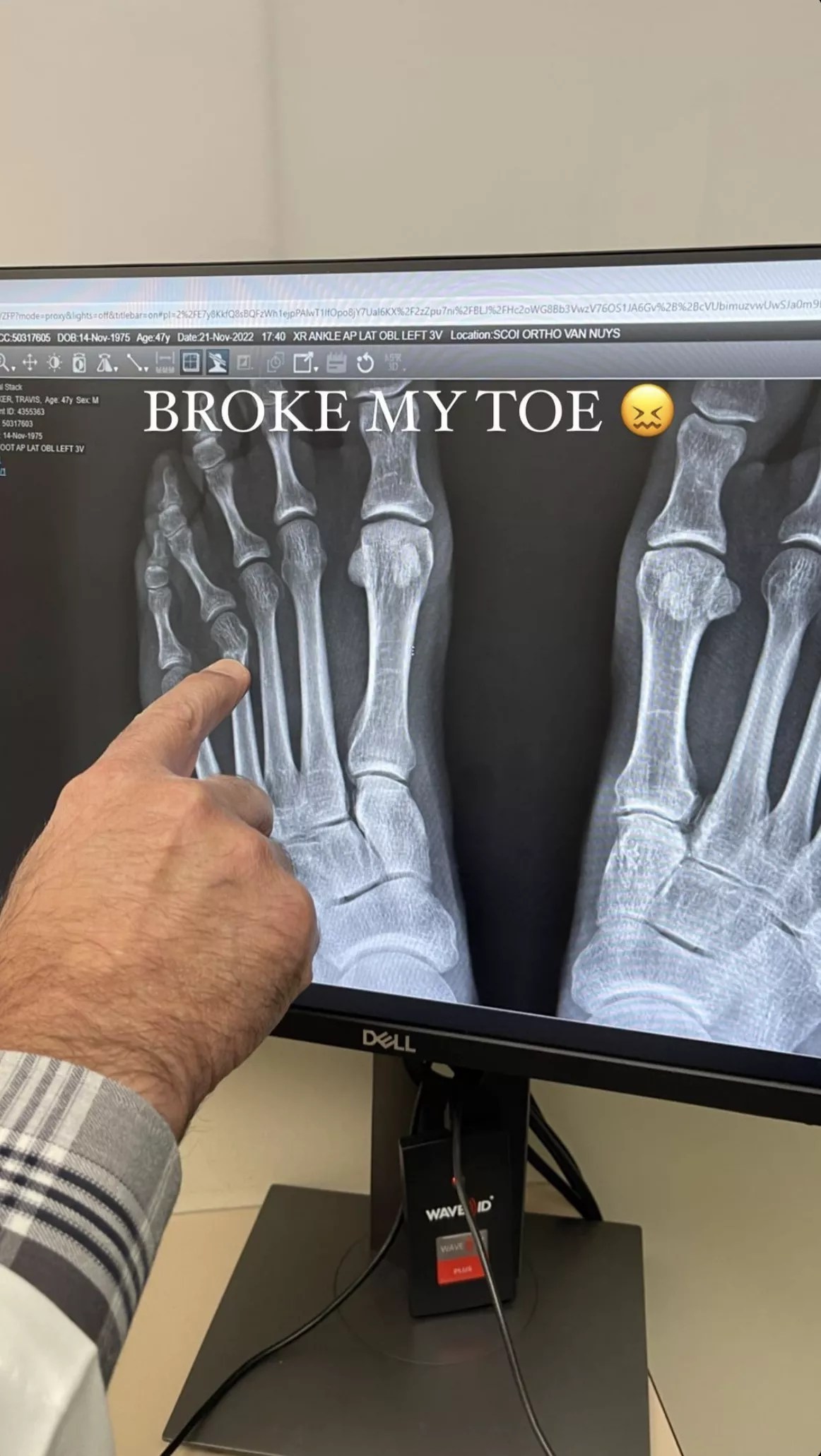 Travis Barker broken toe