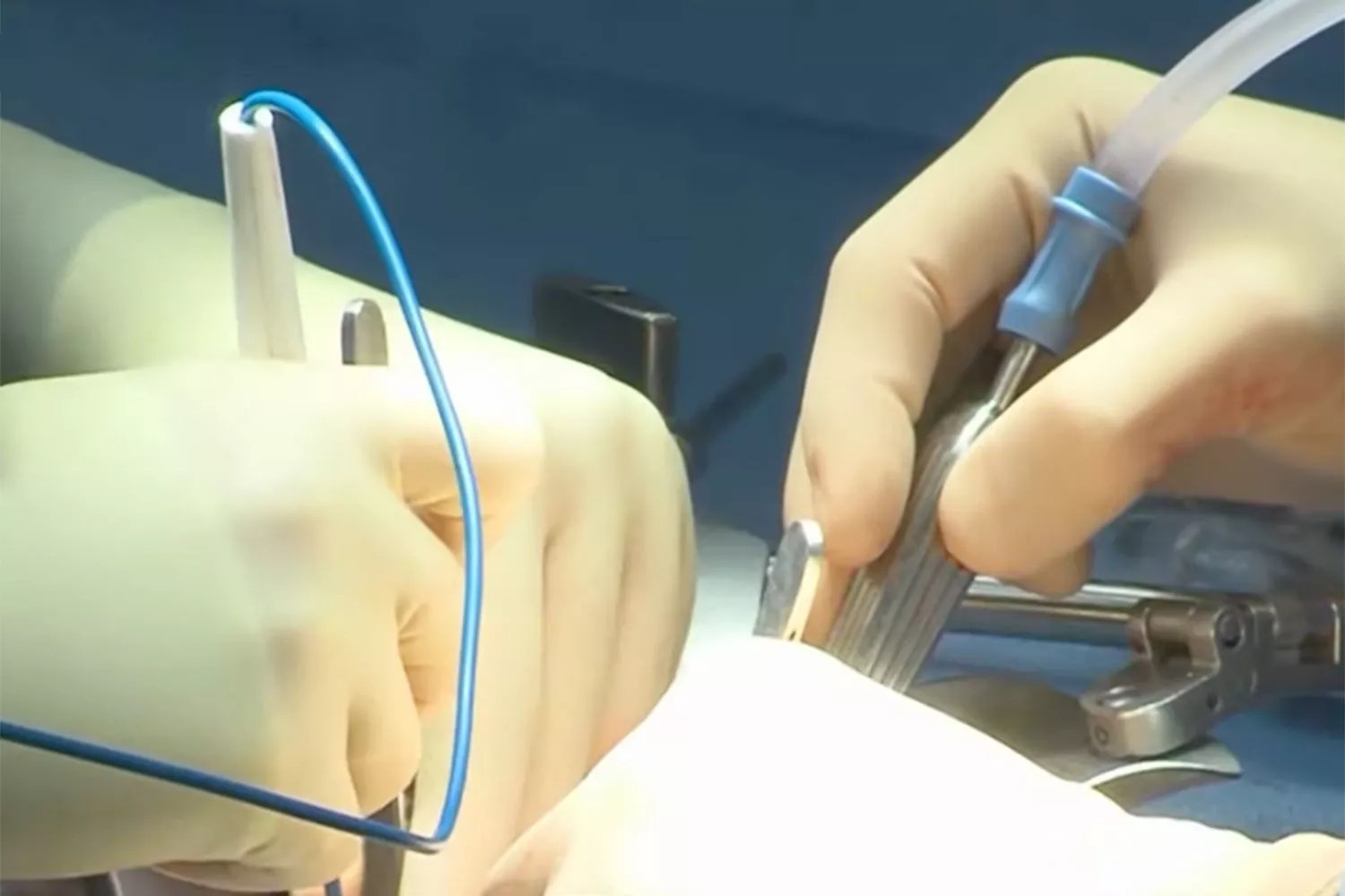 UABâs first uterus transplant recipient delivers healthy baby