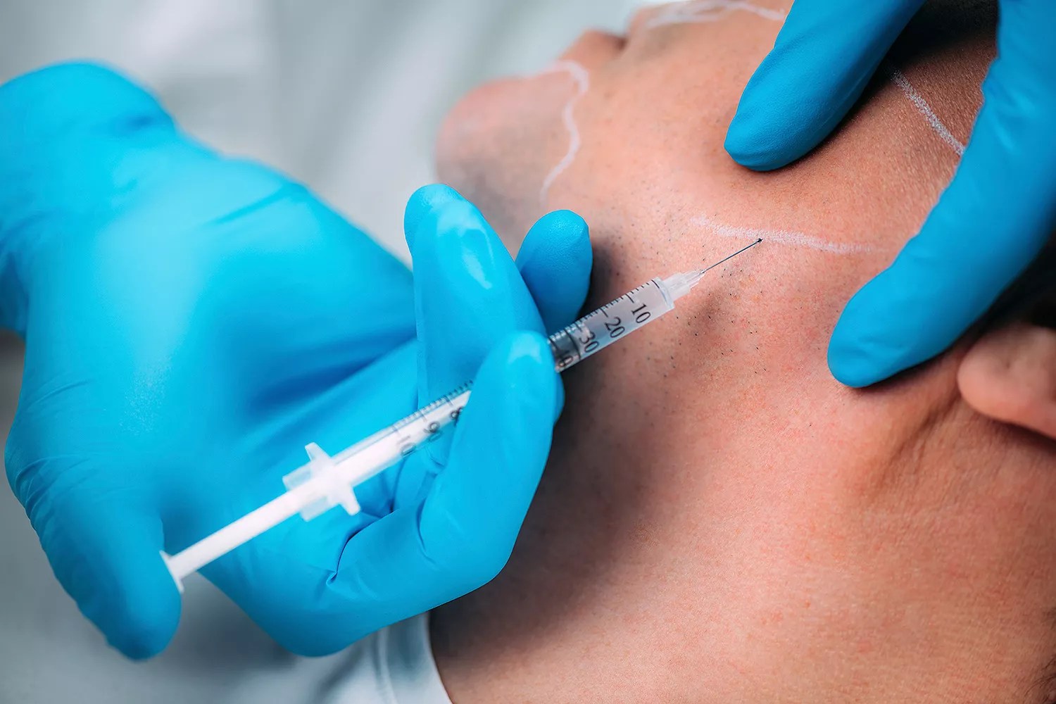Hyaluronic acid fillers.