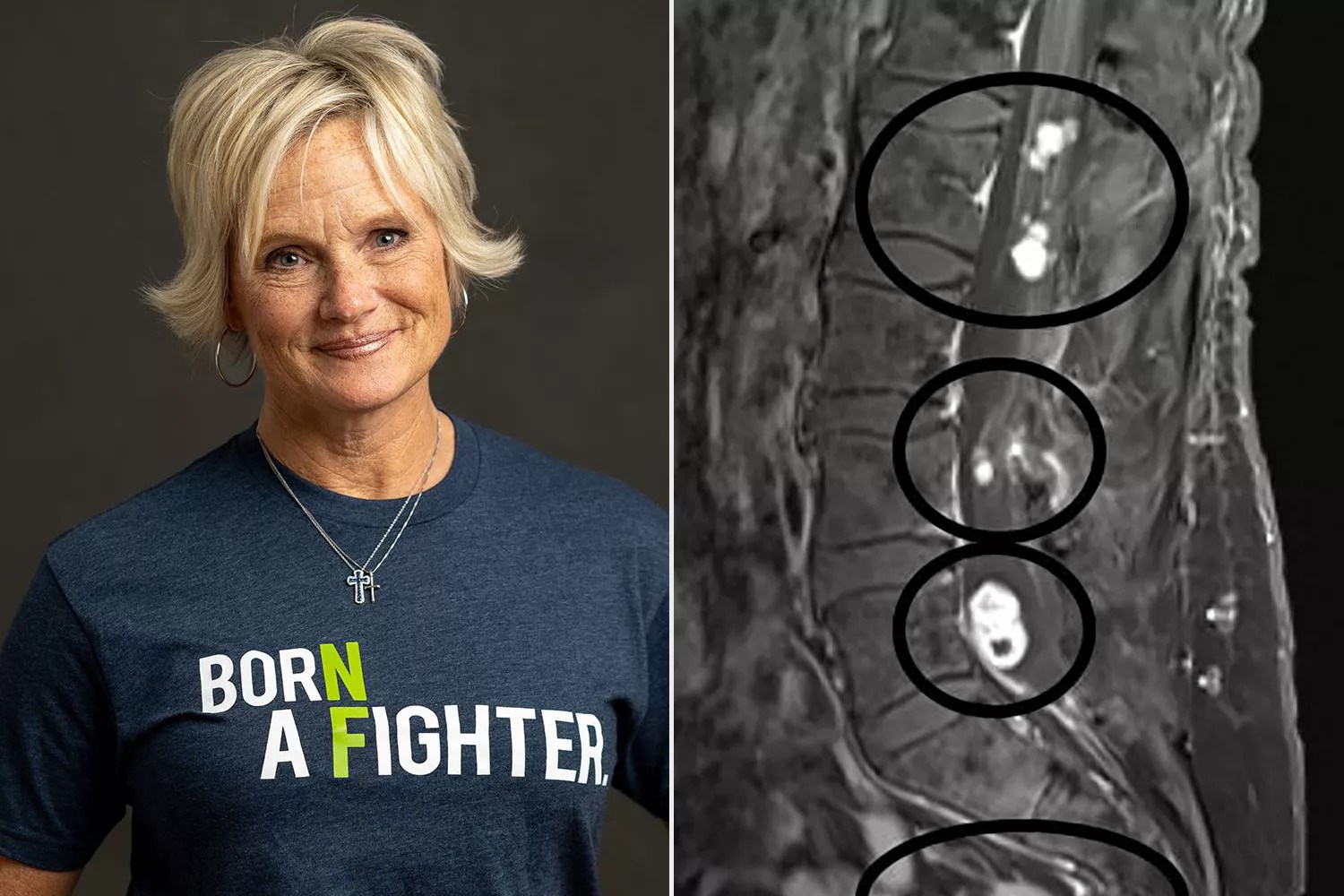 Michelle Holbook MRI showing numerous tumors