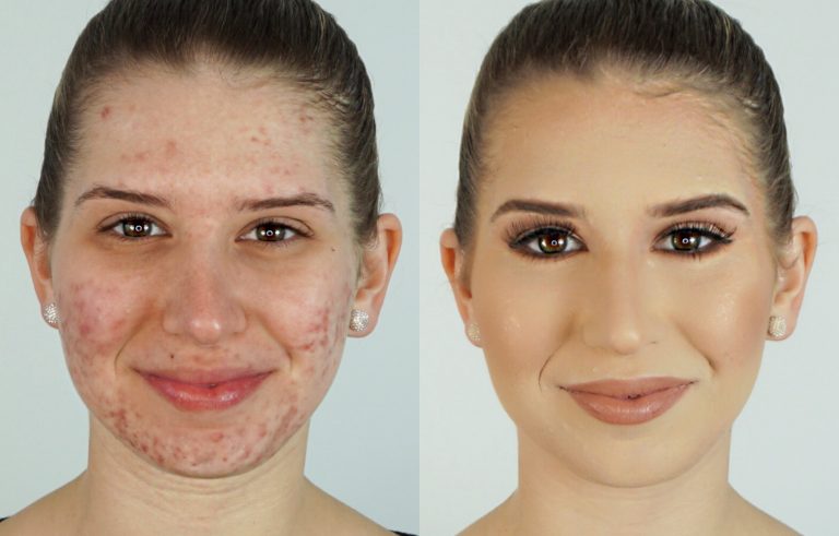 How To Correct And Conceal Acne With Makeup Pepe's How Tos