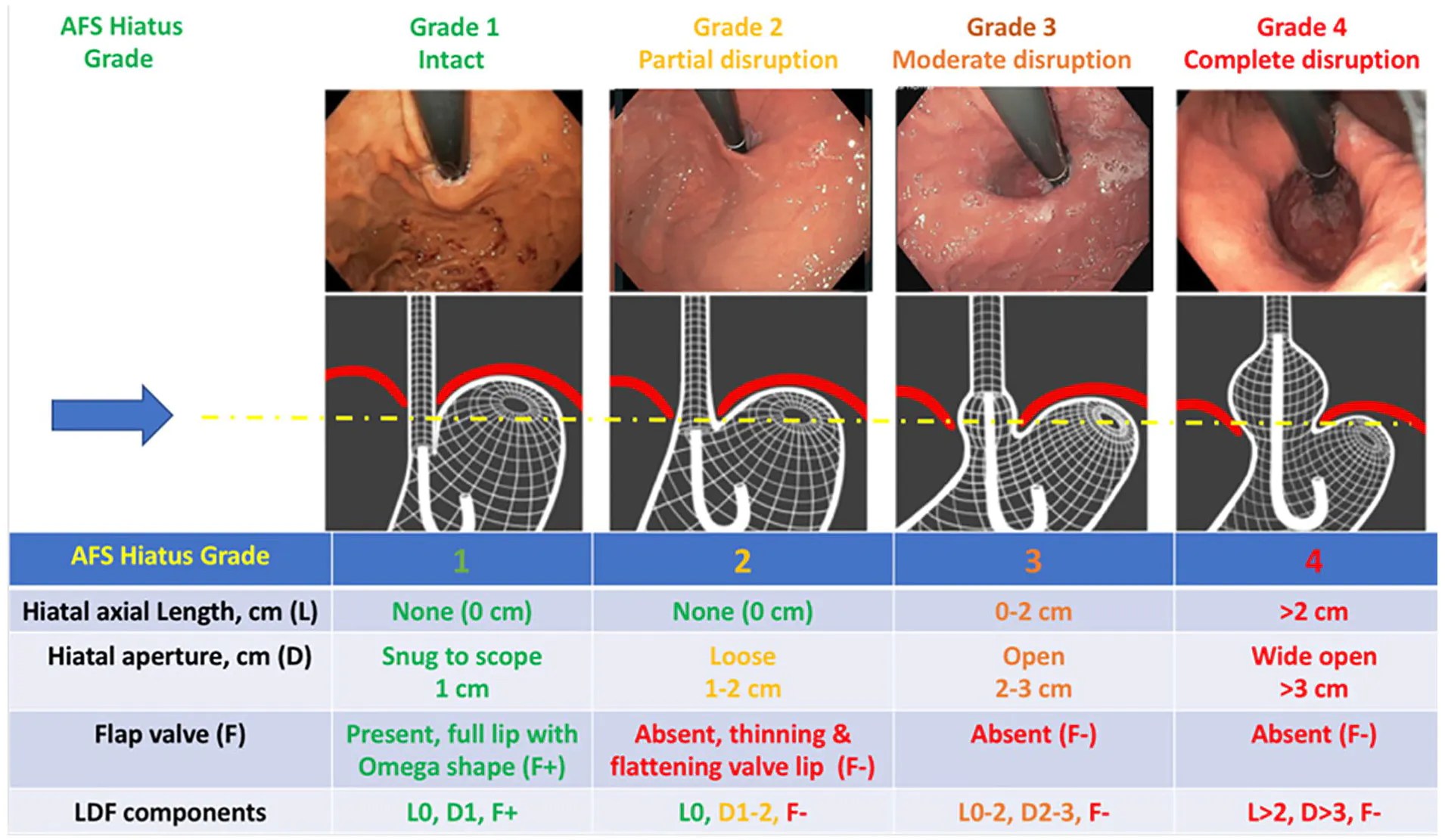 Grading of GERD Hill vs. AFS classification