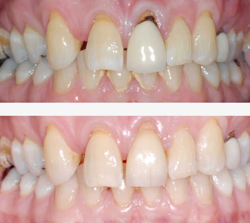 Dental Bonding,Veneers,Crowns,Whitening, Air Flow Cosmetic Dentist in