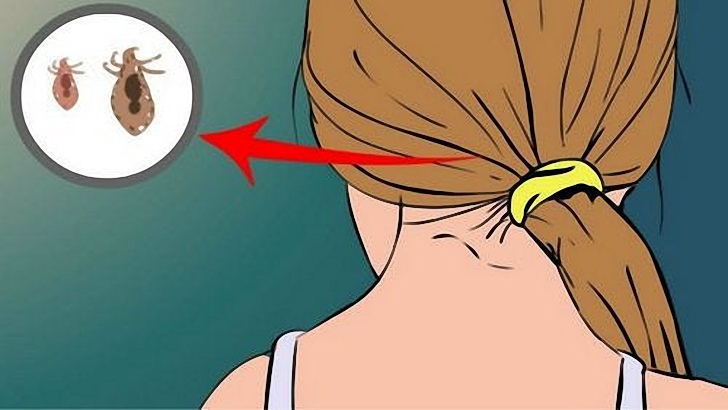 Can Black People Get Lice Perfect Hair Solution