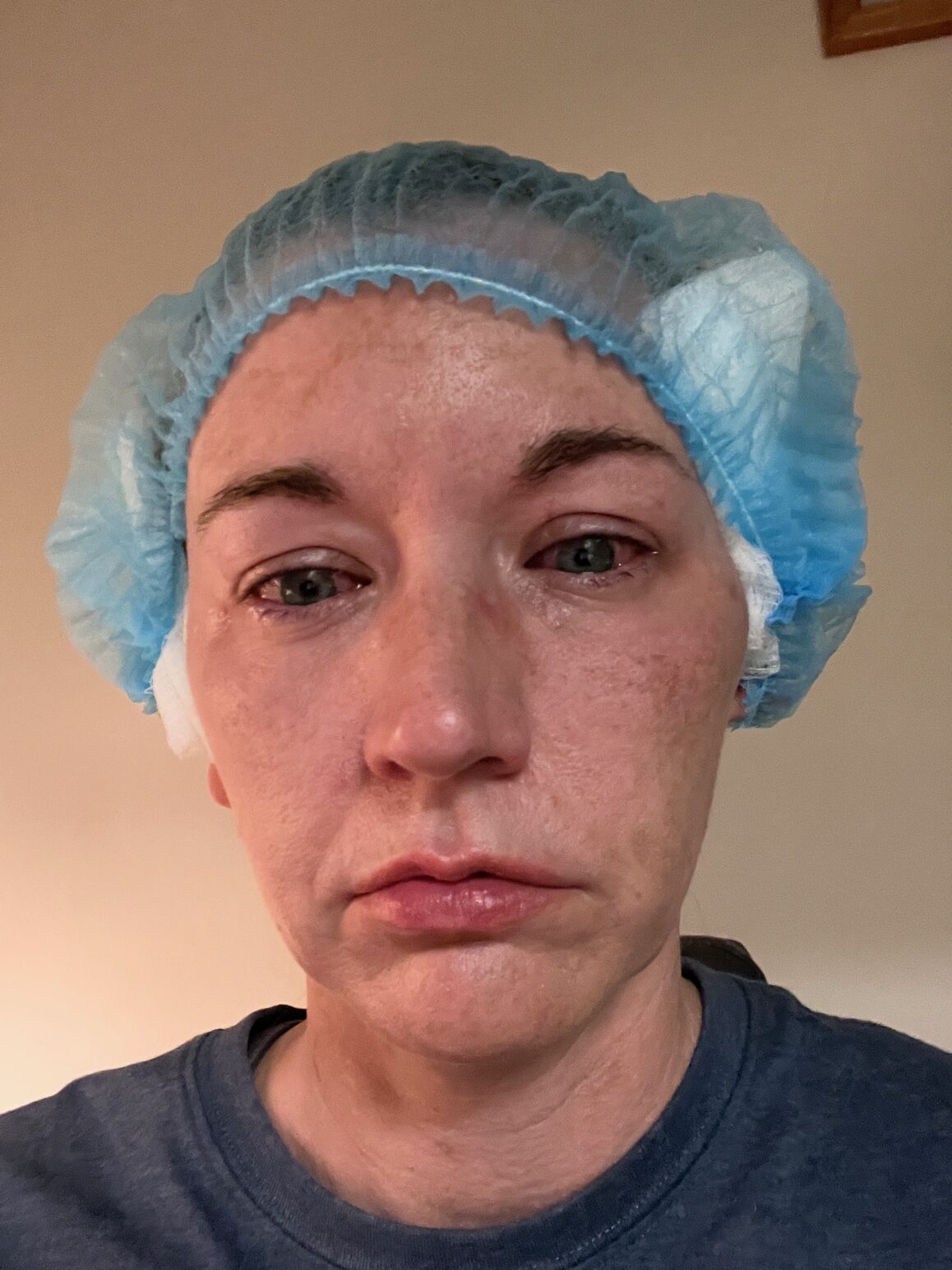 Lasik Eye Surgery in 2023 The Ultimate Guide of Risks & Benefits Perfection Hangover