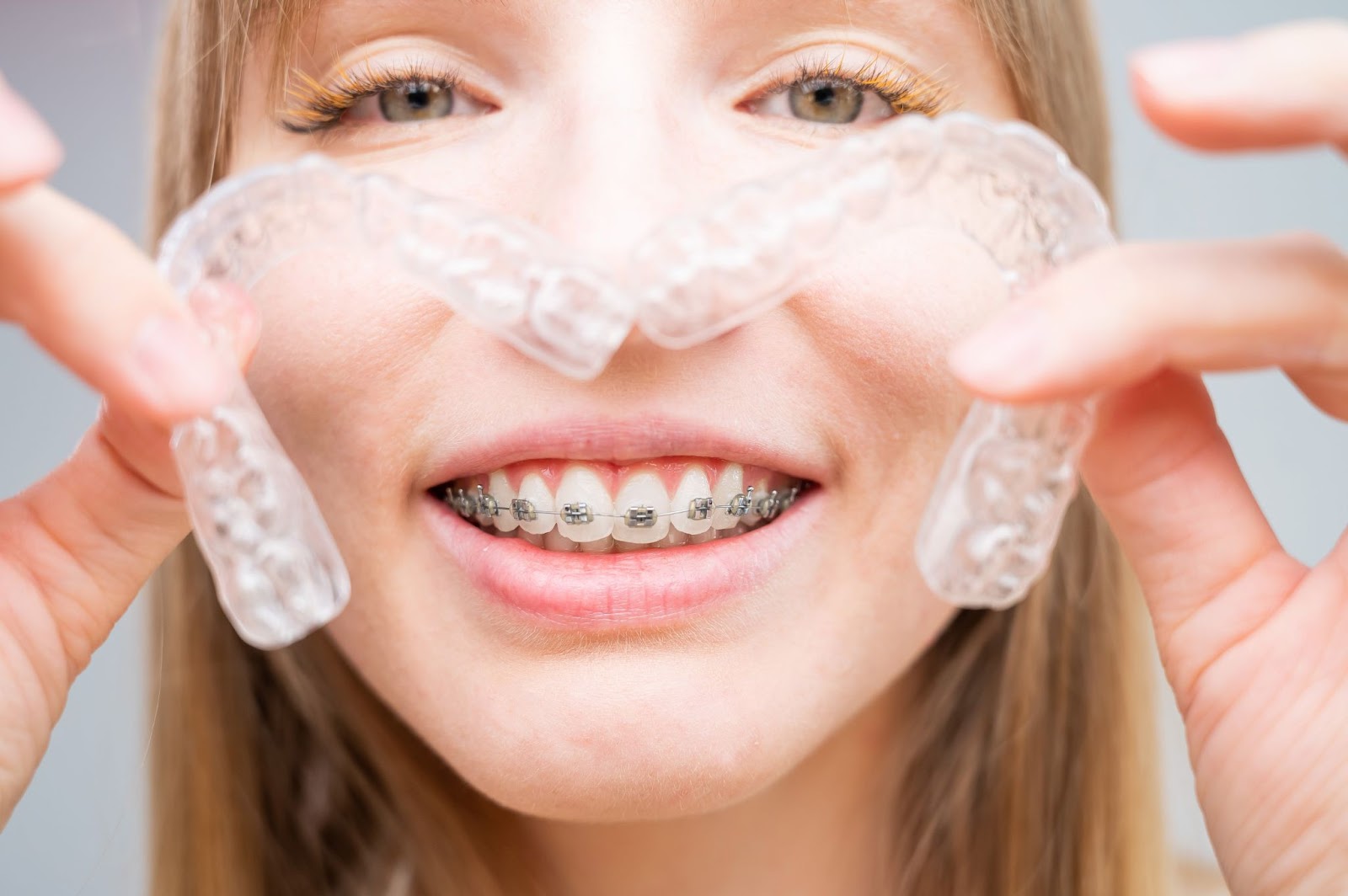 The Difference Between Braces and Clear Aligners Perfect Smile Adelaide