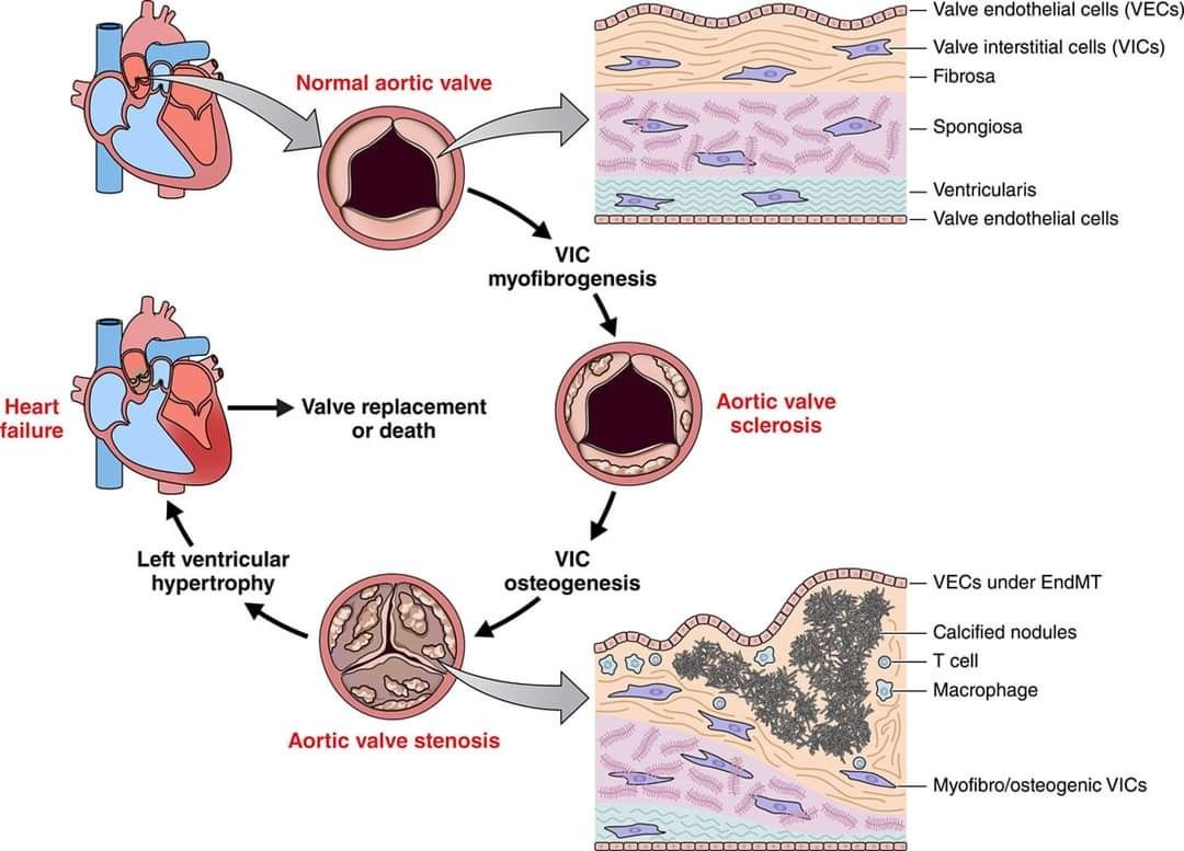 MultiOmics Approaches to Define Calcific Aortic Valve Disease