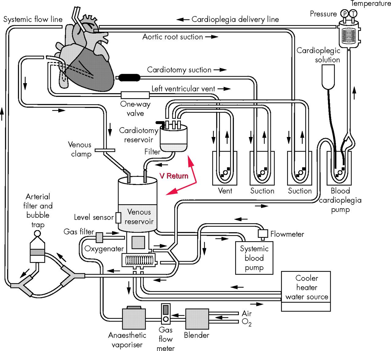 A Locum's ScrapBook A Paradigm Shift The Venous Reservoir Bag