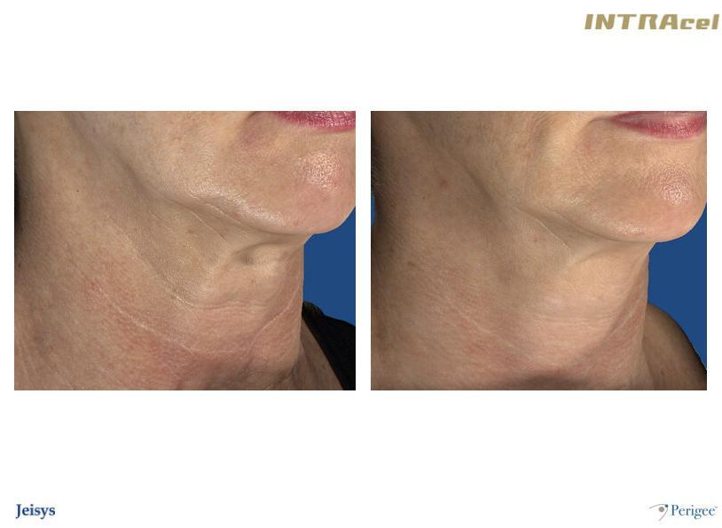 Radio Frequency Microneedling Accent Aesthetics