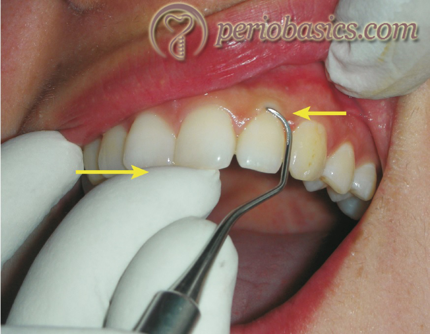 Principles of periodontal instrumentation