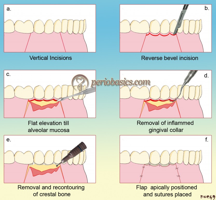 History of surgical periodontal pocket therapy and osseous resective