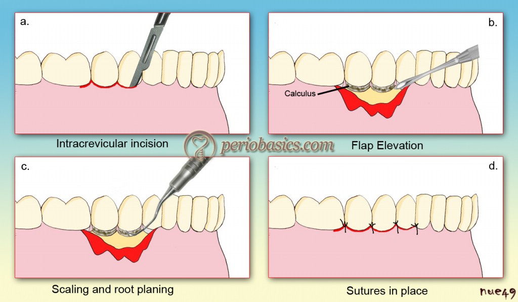 History of surgical periodontal pocket therapy and osseous resective