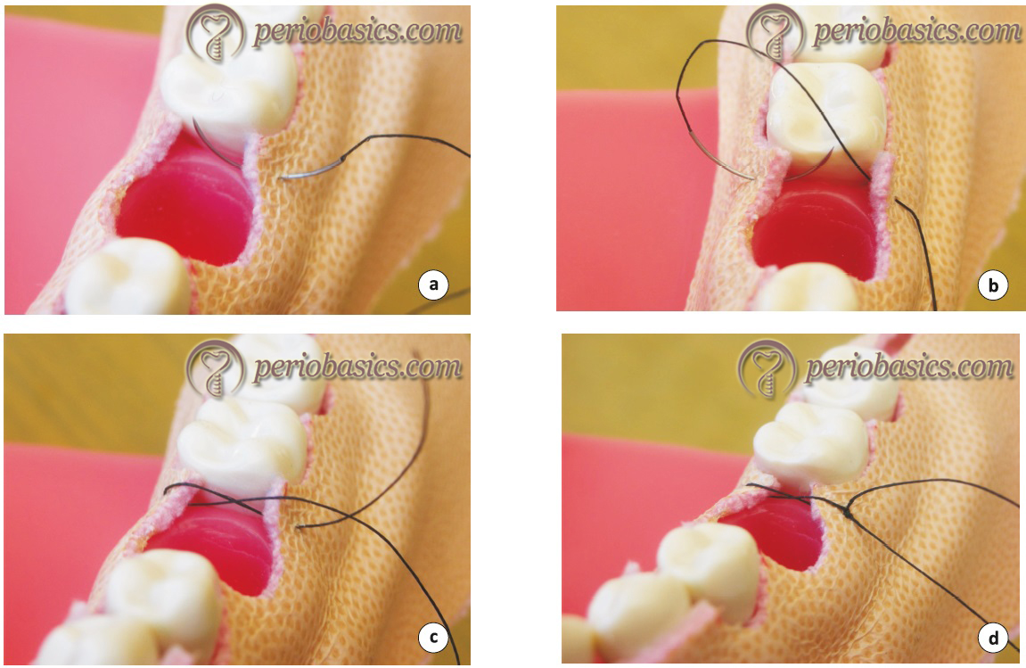Sutures and suturing techniques