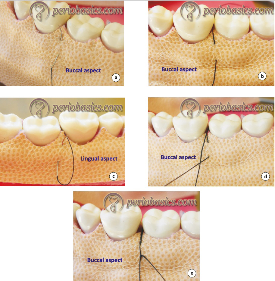 Sutures and suturing techniques