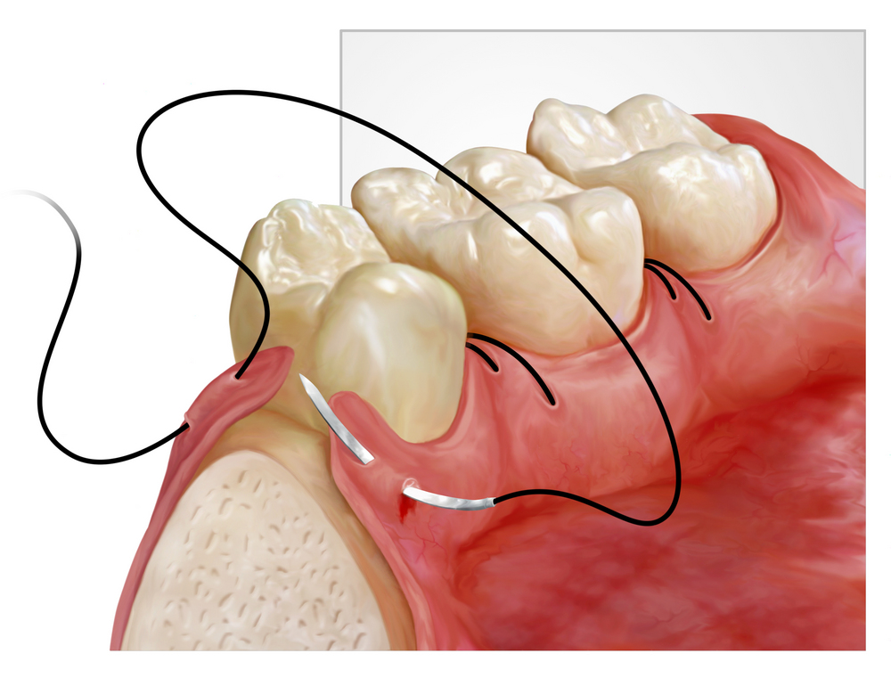 Periodontal Plastic Surgery Dr. Tasoulis D.D.S.