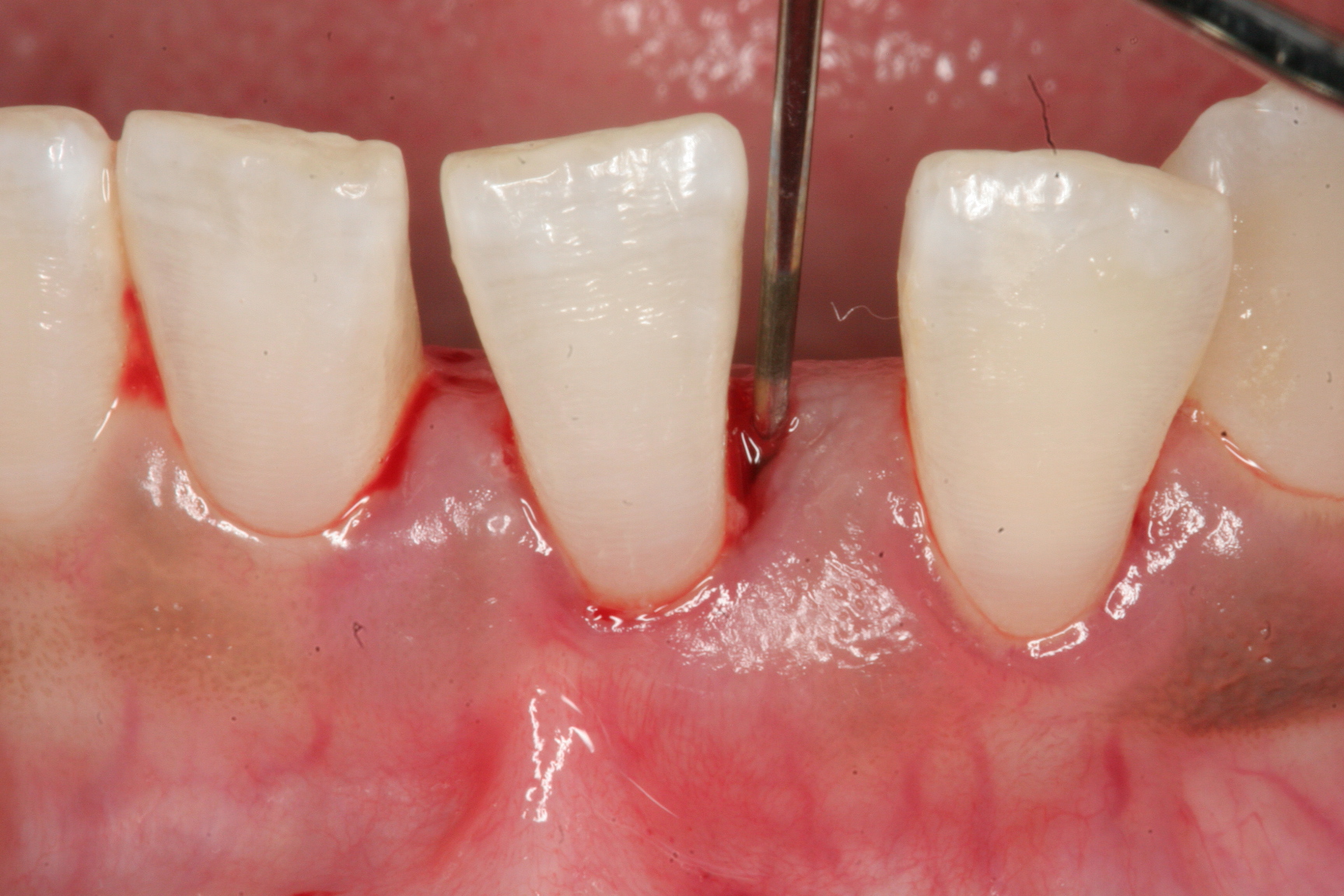 Before and After Pictures of Non Invasive RPE Periodontal Disease