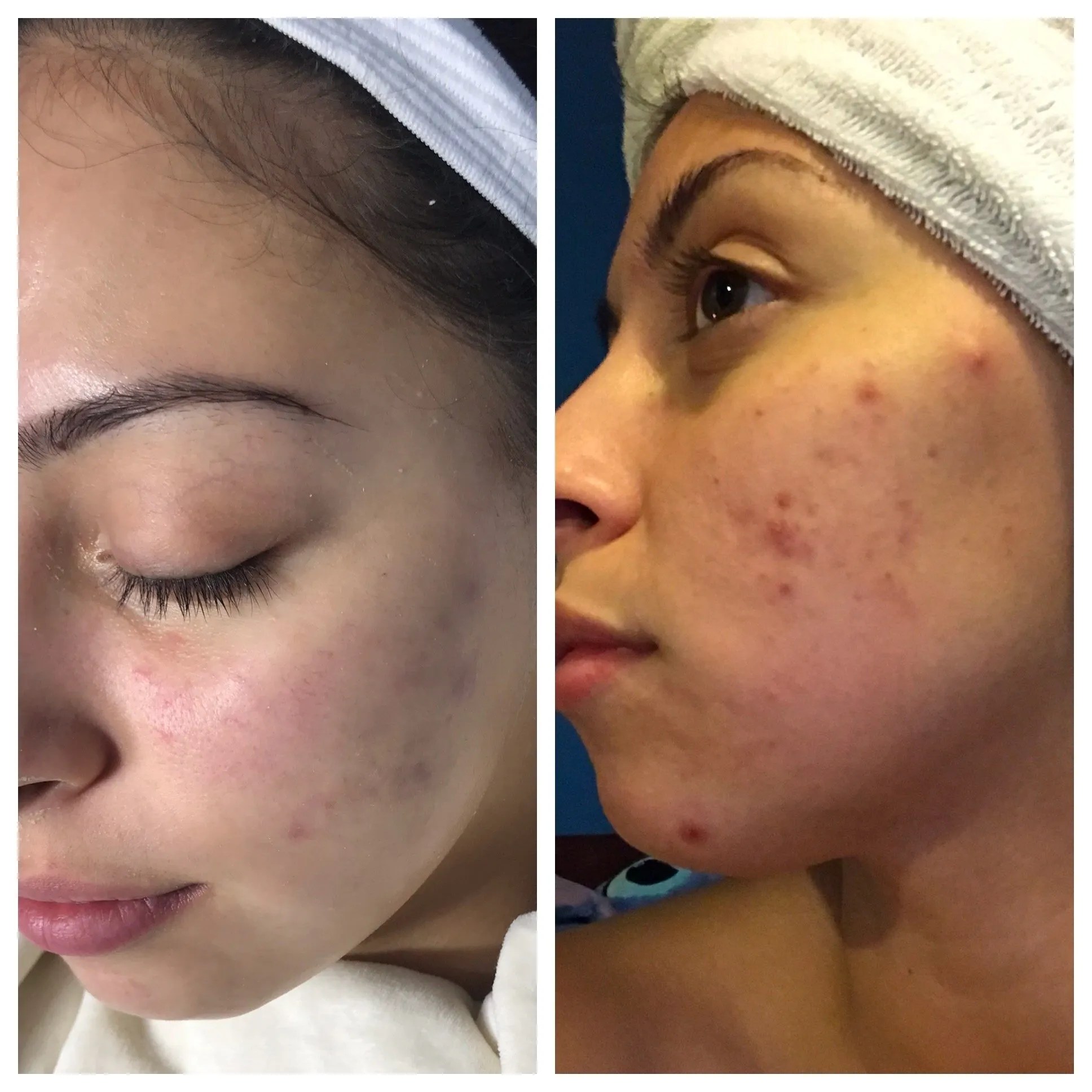 Acne Treatments Personal Esthetics