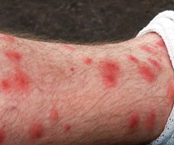 About Chigger Mites Pest Information